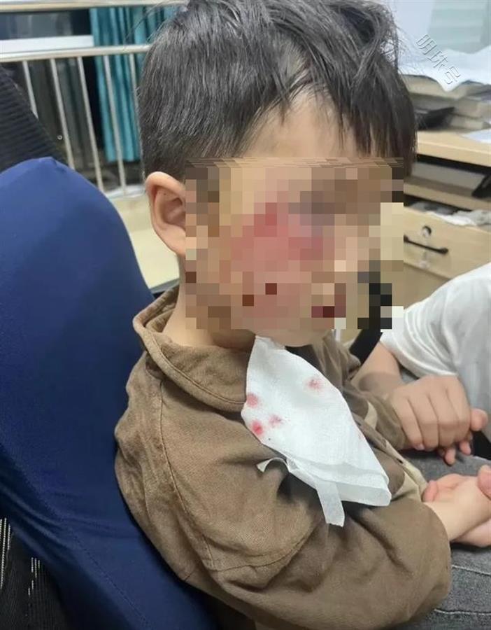 3岁男童被狗咬伤打了疫苗仍离世，农村“狗患”不能再被忽视了！