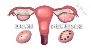 昆明送子鸟：月经不调、体毛多、爆痘……可能是“多囊”找上了门