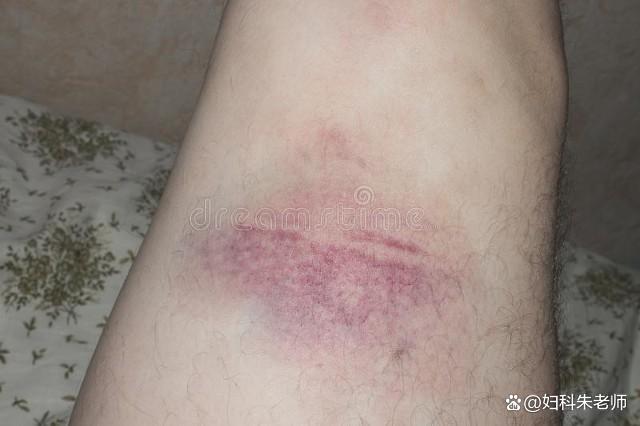 再次提醒：腿上有这种“红血丝”的人，可能是身体发出的危险信号
