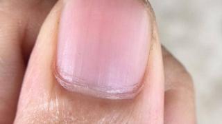 为什么指甲上会有竖纹？指甲若出现异常，或是4种问题的信号