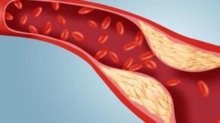 常吃4类食物加速血管硬化，堪称血管的“催老剂”，尽早戒掉