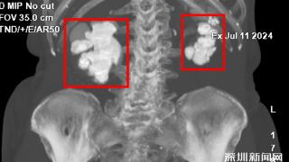 老人肾结石比鸡蛋大！专家0.5厘米单通道“挖矿”