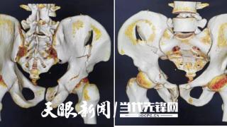 贵州省人民医院：人工智能助力骨盆骨折患者快速康复