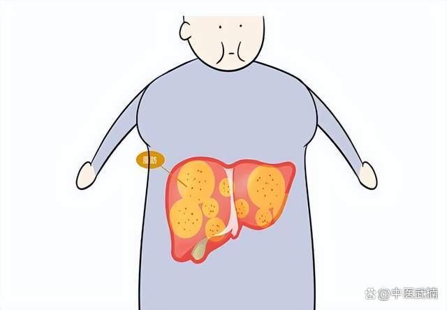 脂肪肝就是一坨痰，中医教你化痰降脂，搞定脂肪肝
