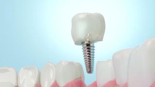 种植牙手术会损伤旁边的神经和血管？
