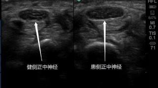 新规发布，“鼠标手”也算职业病