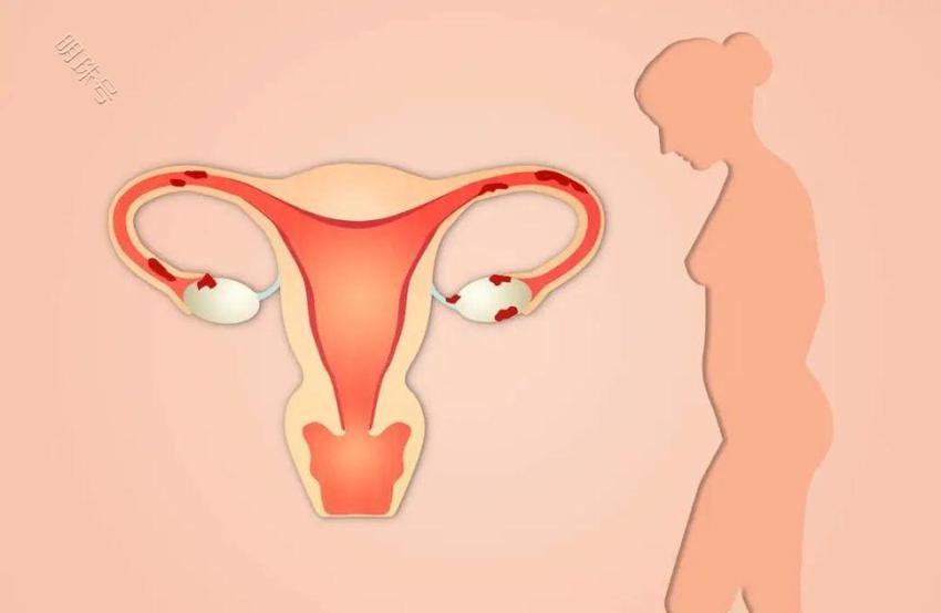 别让宫腔粘连偷走你的生育力，给备孕女性的3点建议！