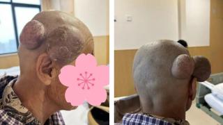 72岁老人头顶长出罕见囊肿 西医二附院为其成功切除