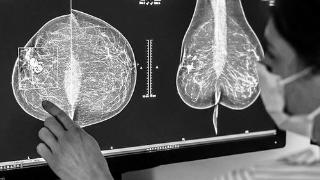 乳腺癌生存率大幅提升