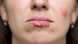 嘴巴周围总是长泡，提醒：这不是上火，可能是唇疱疹，会传染