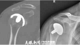 全省首例！贵阳市第四人民医院成功实施一例“人工肩关节表面置换术”