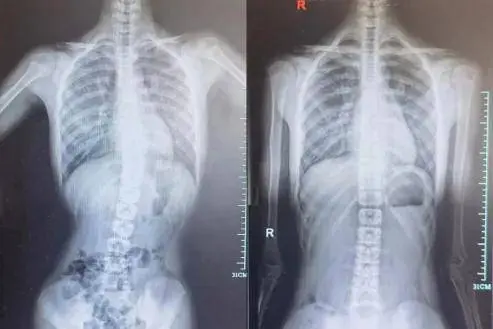 11岁男孩脊柱侧弯，这病愈发常见！