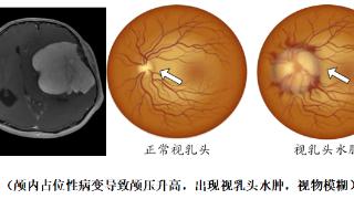 当大脑的颅内压增高时，如何减压呢