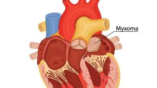 心脏也会长肿瘤吗？心脏粘液瘤是什么？