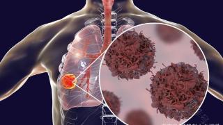 为何肺癌如此容易出现脑转移呢？一文科普下