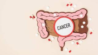 肠癌逐年高发，如何才能预防它“近身”？不妨从这些方面入手！
