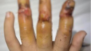 海口6岁男童被奶茶封口机切断三根手指 医生手术6小时成功接活