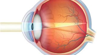 视网膜脱落的前兆，看看你有这5种症状吗？