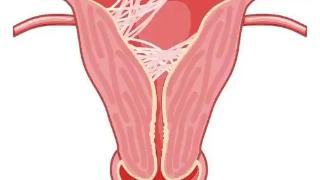 盆腔粘连对怀孕影响大吗?容易导致什么问题?