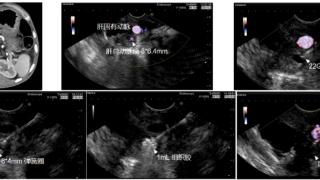 全国首例！山东大学齐鲁医院消化内科超声内镜介入治愈肝总动脉瘤