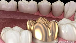 为什么有的种植牙只能选择金属牙冠？