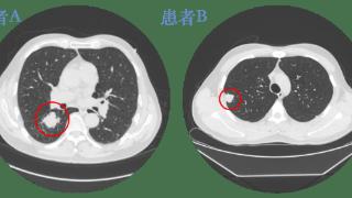 肺结节很常见，但要做好这几点