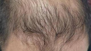 男性脱发真相大揭秘：如何拯救头发不再稀疏！