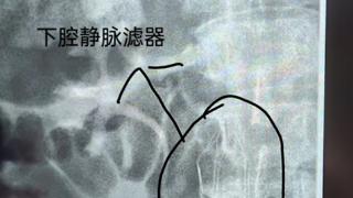薛城区人民医院完成首例深静脉血栓置管吸栓术