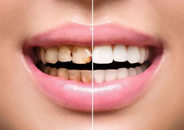 牙齿上有“小黑点”，抠也抠不掉？这多半与3个因素有关，别忽视