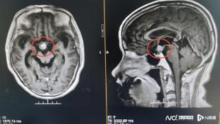 脑肿瘤竟关联上厕所频率，颅咽管瘤患者每天小便近20次