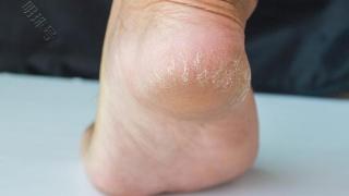 中老年人脚后跟干裂，但不疼痛，是糖尿病的征兆吗？分析下