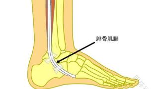 崴脚后，脚踝外侧一直疼痛，什么是腓骨肌腱损伤