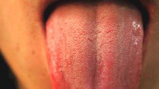 舌头胖大有齿痕是怎么回事？暗示什么问题？