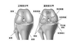 膝骨性关节炎严重，难道只能做全膝关节置换？