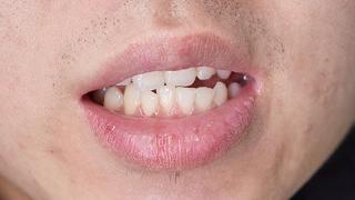 嘴唇老是干裂起皮，是什么原因？