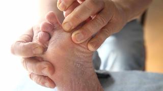 感染脚气，瘙痒难耐？这多半与3个因素有关，需尽早避开！