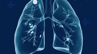 海报图品｜世界防治结核病日：守护健康呼吸