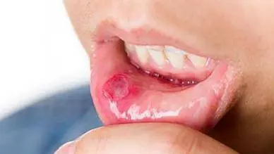 体内有癌，嘴知道？口腔出现4种现象，或许是癌细胞在活跃