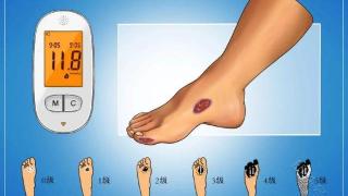 脚部出现5个信号，或预示“糖尿病足”，4个方法来预防