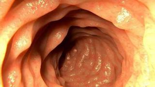 肠癌多半是拖出来的，身体出现3种异常，可能需要做肠镜